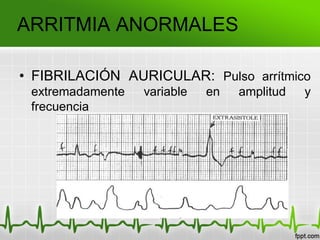 ARRITMIA ANORMALES
• FIBRILACIÓN AURICULAR: Pulso arrítmico
extremadamente variable en amplitud y
frecuencia
 