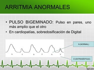 ARRITMIA ANORMALES
• PULSO BIGEMINADO: Pulso en pares, uno
más amplio que el otro
• En cardiopatías, sobredosificación de Digital
E (EXTRASÍSTOLE)
N (NORMAL)
 