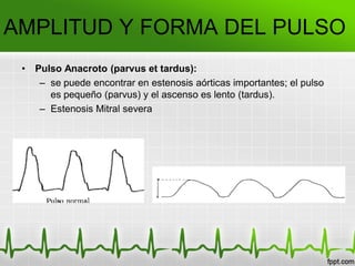 AMPLITUD Y FORMA DEL PULSO
• Pulso Anacroto (parvus et tardus):
– se puede encontrar en estenosis aórticas importantes; el pulso
es pequeño (parvus) y el ascenso es lento (tardus).
– Estenosis Mitral severa
 