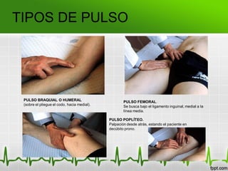 TIPOS DE PULSO
PULSO FEMORAL.
Se busca bajo el ligamento inguinal, medial a la
línea media.
PULSO BRAQUIAL O HUMERAL
(sobre el pliegue el codo, hacia medial).
PULSO POPLÍTEO.
Palpación desde atrás, estando el paciente en
decúbito prono.
 