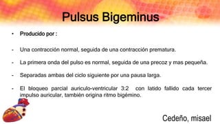 Pulsus Bigeminus
• Producido por :
- Una contracción normal, seguida de una contracción prematura.
- La primera onda del pulso es normal, seguida de una precoz y mas pequeña.
- Separadas ambas del ciclo siguiente por una pausa larga.
- El bloqueo parcial auriculo-ventricular 3:2 con latido fallido cada tercer
impulso auricular, también origina ritmo bigémino.
Cedeño, misael
 