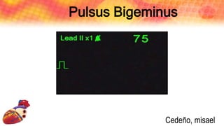 Pulsus Bigeminus
Cedeño, misael
 