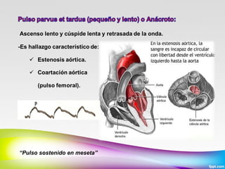 “Pulso sostenido en meseta”

 