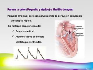 Pequeña amplitud, pero con abrupta onda de percusión seguida de
un colapso rápido.
-Es hallazgo característico de:
 Estenosis mitral.
 Algunos casos de defecto
del tabique ventricular.

 