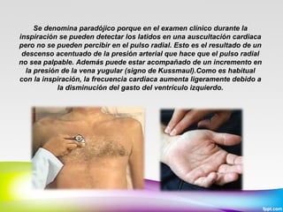 Se denomina paradójico porque en el examen clínico durante la
inspiración se pueden detectar los latidos en una auscultación cardiaca
pero no se pueden percibir en el pulso radial. Esto es el resultado de un
descenso acentuado de la presión arterial que hace que el pulso radial
no sea palpable. Además puede estar acompañado de un incremento en
la presión de la vena yugular (signo de Kussmaul).Como es habitual
con la inspiración, la frecuencia cardiaca aumenta ligeramente debido a
la disminución del gasto del ventrículo izquierdo.

 