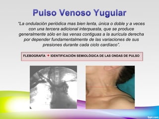 “La ondulación periódica mas bien lenta, única o doble y a veces
con una tercera adicional interpuesta, que se produce
generalmente sólo en las venas contiguas a la aurícula derecha
por depender fundamentalmente de las variaciones de sus
presiones durante cada ciclo cardíaco”.
FLEBOGRAFÍA

+ IDENTIFICACIÓN SEMIOLÓGICA DE LAS ONDAS DE PULSO

 