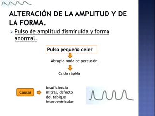  Pulso de amplitud disminuida y forma
anormal.
Pulso pequeño celer
Abrupta onda de percusión
Caída rápida
Causas
Insuficiencia
mitral, defecto
del tabique
interventricular
 