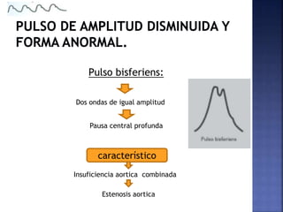 Pulso bisferiens:
característico
Insuficiencia aortica combinada
Estenosis aortica
Dos ondas de igual amplitud
Pausa central profunda
 