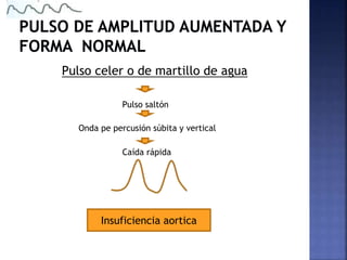 Pulso celer o de martillo de agua
Pulso saltón
Onda pe percusión súbita y vertical
Caída rápida
Insuficiencia aortica
 