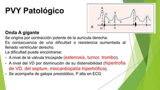 PVY Patológico
Onda A gigante
Se origina por contracción potente de la aurícula derecha.
Es consecuencia de una dificultad o resistencia aumentada al
llenado ventricular derecho.
La dificultad puede encontrarse:
- A nivel de la válvula tricúspide (estenosis, tumor, trombo).
- A nivel del VD por disminución de su distensibilidad (hipertrofia
de VD, del septum, miocardiopatía hipertrófica).
- Se acompaña de galope presistólico, P alta en ECG
 