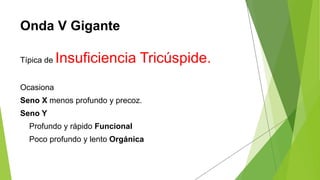 Onda V Gigante
Típica de Insuficiencia Tricúspide.
Ocasiona
Seno X menos profundo y precoz.
Seno Y
Profundo y rápido Funcional
Poco profundo y lento Orgánica
 