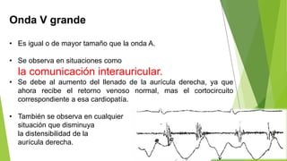 Onda V grande
• Es igual o de mayor tamaño que la onda A.
• Se observa en situaciones como
la comunicación interauricular.
• Se debe al aumento del llenado de la aurícula derecha, ya que
ahora recibe el retorno venoso normal, mas el cortocircuito
correspondiente a esa cardiopatía.
• También se observa en cualquier
situación que disminuya
la distensibilidad de la
aurícula derecha.
 