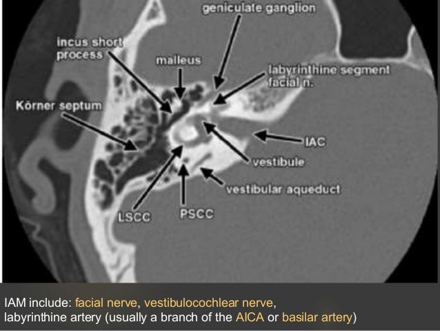 Pulstaile tinitus radiology