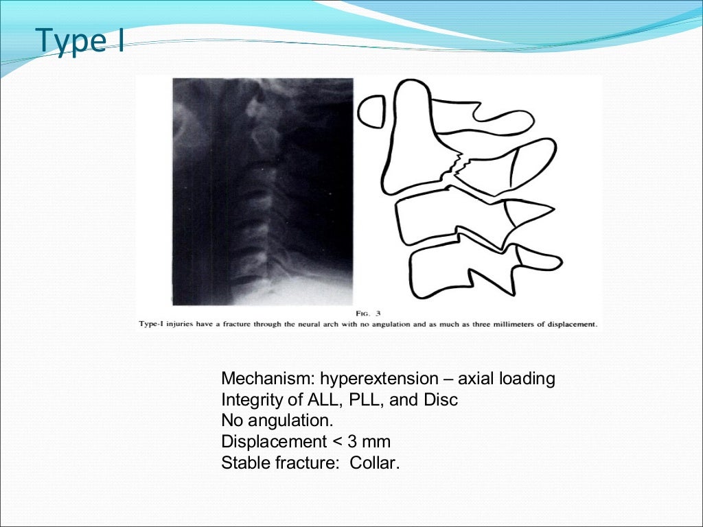 Traumatic Spondylolisthesis