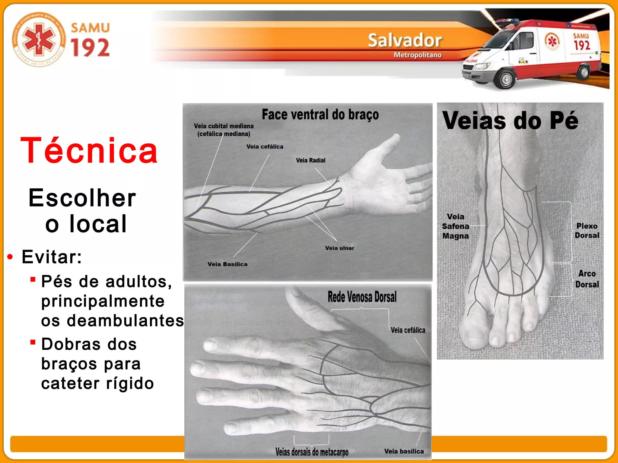 Técnica
  Escolher
   o local
• Evitar:
   Pés de adultos,
    principalmente
    os deambulantes
   Dobras dos
    braços para
    cateter rígido
 