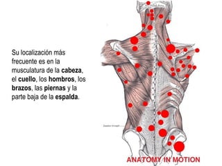 Su localización más
frecuente es en la
musculatura de la cabeza,
el cuello, los hombros, los
brazos, las piernas y la
parte baja de la espalda.
 