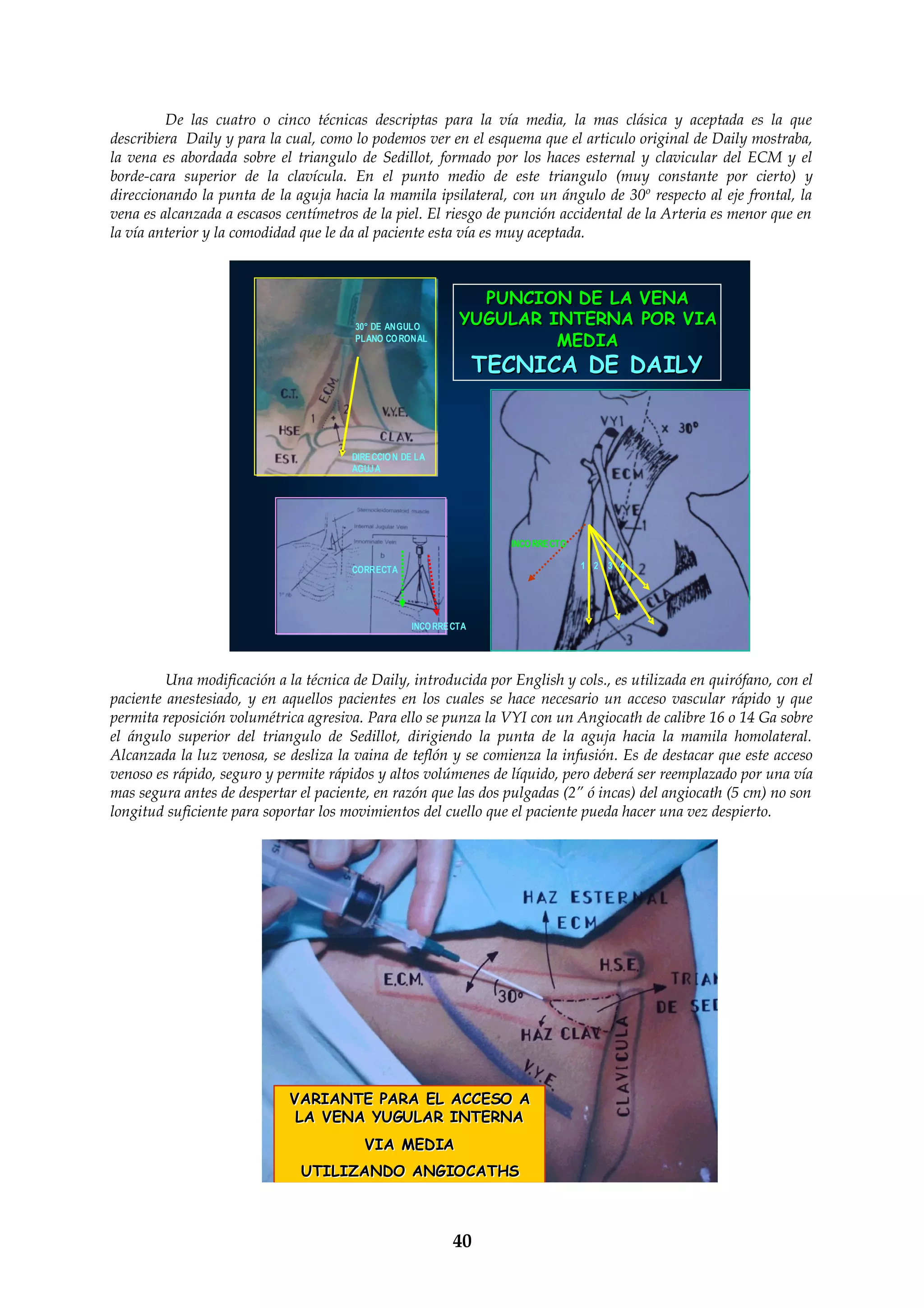 Punciones venosas centrales como lo hago | DOC