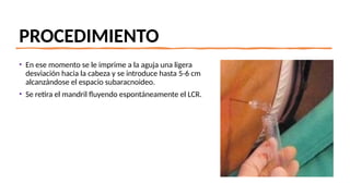 PROCEDIMIENTO
• En ese momento se le imprime a la aguja una ligera
desviación hacia la cabeza y se introduce hasta 5-6 cm
alcanzándose el espacio subaracnoideo.
• Se retira el mandril fluyendo espontáneamente el LCR.
 