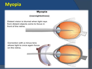 Myopia
 
