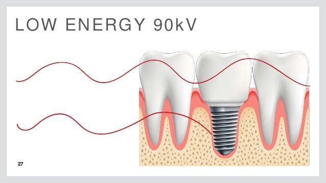 CBCT: Low Dose & High Resolution Endo