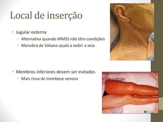 Local de inserção
• Jugular externa
• Alternativa quando MMSS não têm condições
• Manobra de Valsava ajuda a exibir a veia
• Membros inferiores devem ser evitados
• Mais risco de trombose venosa
 