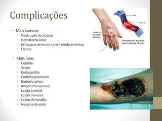 Complicações
• Mais comuns
• Obstrução do acesso
• Hematoma local
• Extravasamento de soro / medicamentos
• Flebite
• Mais raras
• Celulite
• Sepse
• Endocardite
• Embolia pulmonar
• Embolia aérea
• Aneurisma venoso
• Lesão arterial
• Lesão nervosa
• Lesão de tendão
• Necrose de pele
 