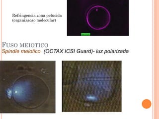 Refringencia zona pelucida
    (organizacao molecular)




FUSO MEIOTICO
Spindle meiotico (OCTAX ICSI Guard)- luz polarizada
 