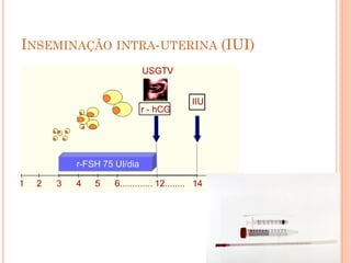 INSEMINAÇÃO INTRA-UTERINA (IUI)
 