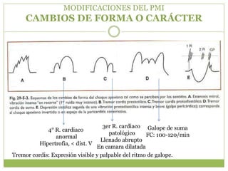 MODIFICACIONES DEL PMI
     CAMBIOS DE FORMA O CARÁCTER




                                    3er R. cardiaco Galope de suma
             4° R. cardiaco
                                      patológico     FC: 100-120/min
                anormal
                                   Llenado abrupto
          Hipertrofia, < dist. V
                                 En camara dilatada
Tremor cordis: Expresión visible y palpable del ritmo de galope.
 