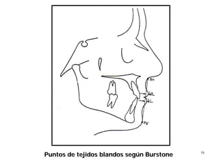 1515
Puntos de tejidos blandos segPuntos de tejidos blandos segúúnn BurstoneBurstone
 