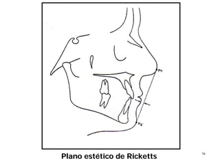 1616
Plano estPlano estéético detico de RickettsRicketts
 