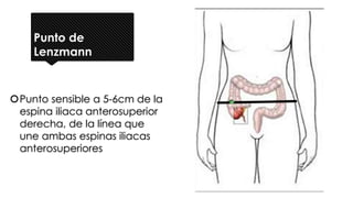 Punto de
Lenzmann
Punto sensible a 5-6cm de la
espina iliaca anterosuperior
derecha, de la línea que
une ambas espinas iliacas
anterosuperiores
 