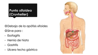 Punto xifoideo
(Cruvhelier)
Debajo de la apófisis xifoides
Sirve para :
- Esofagitis
- Hernia de hiato
- Gastritis
- Ulcera techo gástrico
 