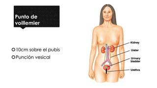Punto de
voillemier
10cm sobre el pubis
Punción vesical
 