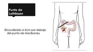 Punto de
Lothlissen
Localizado a 5cm por debajo
del punto de MacBurney
 