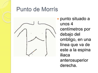 Punto de Morrís 
 punto situado a 
unos 4 
centímetros por 
debajo del 
ombligo, en una 
línea que va de 
este a la espina 
iliaca 
anterosuperior 
derecha. 
 