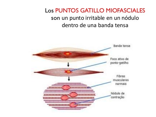 Resultado de imagen para punto gatillo