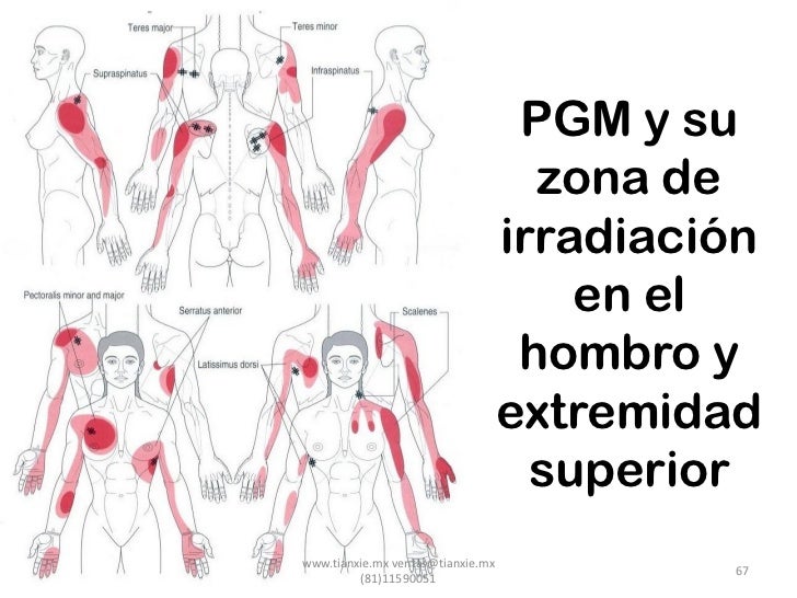 Resultado de imagen para punto gatillo