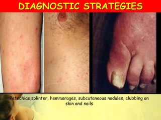 Petechiae,splinter, hemmorages, subcutaneous nodules, clubbing on
skin and nails
DIAGNOSTIC STRATEGIES
 