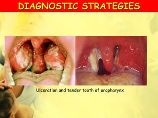 Ulceration and tender tooth of oropharynx
DIAGNOSTIC STRATEGIES
 