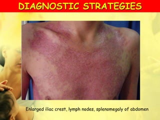 Enlarged iliac crest, lymph nodes, splenomegaly of abdomen
DIAGNOSTIC STRATEGIES
 