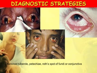 Chancroid tubercle, petechiae, roth’s spot of fundi or conjunctiva
DIAGNOSTIC STRATEGIES
 