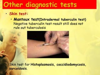 Other diagnostic tests
• Skin test:
• Mantoux test(Intradermal tuberculin test)
Negative tuberculin test result still does not
rule out tuberculosis
• Skin test for Histoplasmosis, coccidiodomycosis,
sarcoidosis.
 