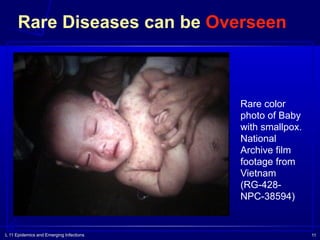 L 11 Epidemics and Emerging Infections 11
Rare Diseases can be Overseen
Rare color
photo of Baby
with smallpox.
National
Archive film
footage from
Vietnam
(RG-428-
NPC-38594)
 