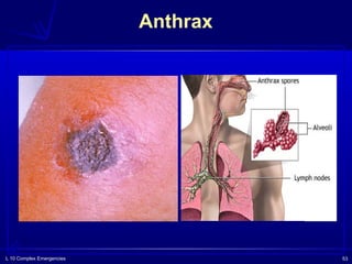 L 10 Complex Emergencies 53
Anthrax
❑
 