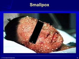 L 10 Complex Emergencies 55
Smallpox
❑
 