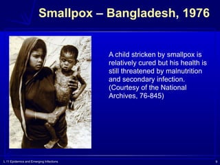 L 11 Epidemics and Emerging Infections 9
Smallpox – Bangladesh, 1976
A child stricken by smallpox is
relatively cured but his health is
still threatened by malnutrition
and secondary infection.
(Courtesy of the National
Archives, 76-845)
 