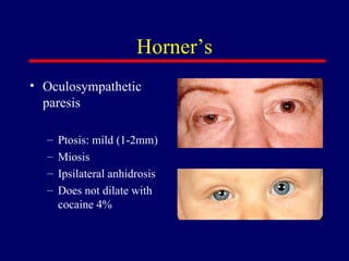 Horner’s Oculosympathetic paresis Ptosis:  mild (1-2mm)  Miosis Ipsilateral anhidrosis Does not dilate with cocaine 4% 