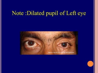 Note :Dilated pupil of Left eye
 