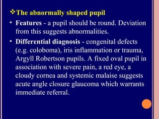 The abnormally shaped pupil
• Features - a pupil should be round. Deviation
from this suggests abnormalities.
• Differential diagnosis - congenital defects
(e.g. coloboma), iris inflammation or trauma,
Argyll Robertson pupils. A fixed oval pupil in
association with severe pain, a red eye, a
cloudy cornea and systemic malaise suggests
acute angle closure glaucoma which warrants
immediate referral.
 